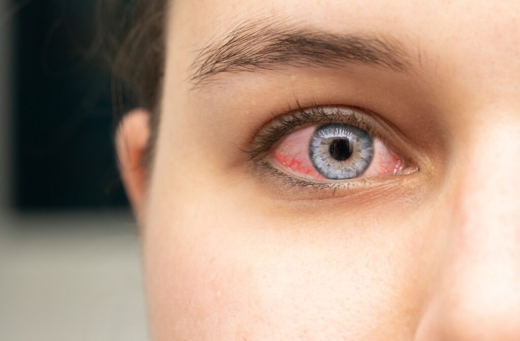 Close-up of a person's eye that's red and irritated, possibly due to pink eye.